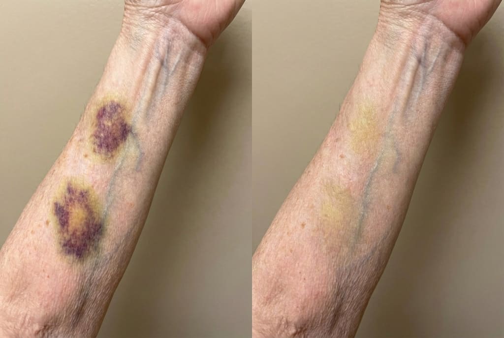 Avyelo - Bruise Repair & Skin-Strengthening Cream