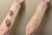 Avyelo - Bruise Repair & Skin-Strengthening Cream