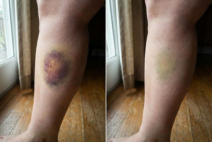 Avyelo - Bruise Repair & Skin-Strengthening Cream