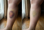Avyelo - Bruise Repair & Skin-Strengthening Cream